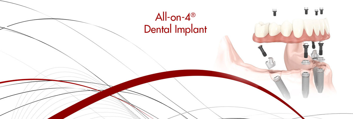 Katy All-on-4 Dental Implants