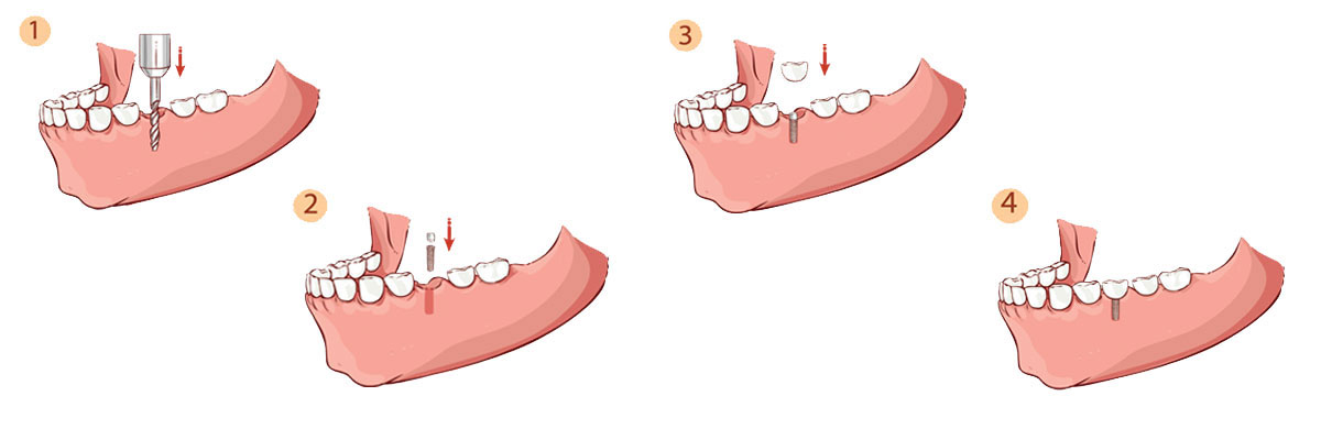 Katy Dental Implant Restoration