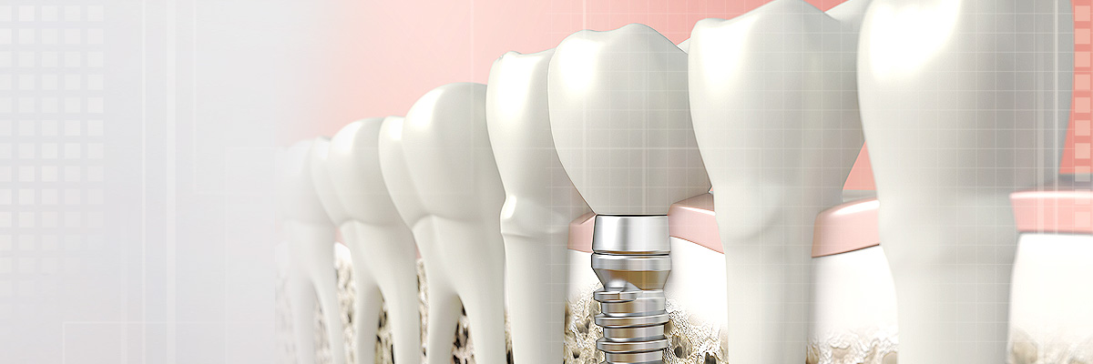 Katy Implant Dentist
